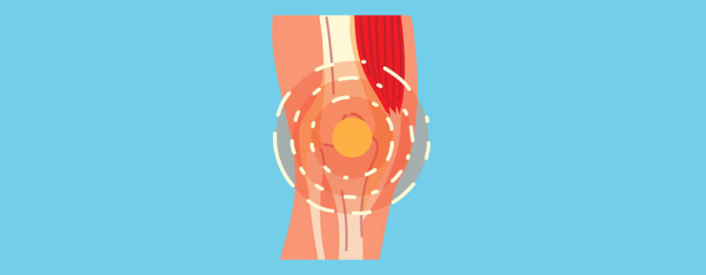 The Role of Inflammation in Knee Pain: Causes and Treatments