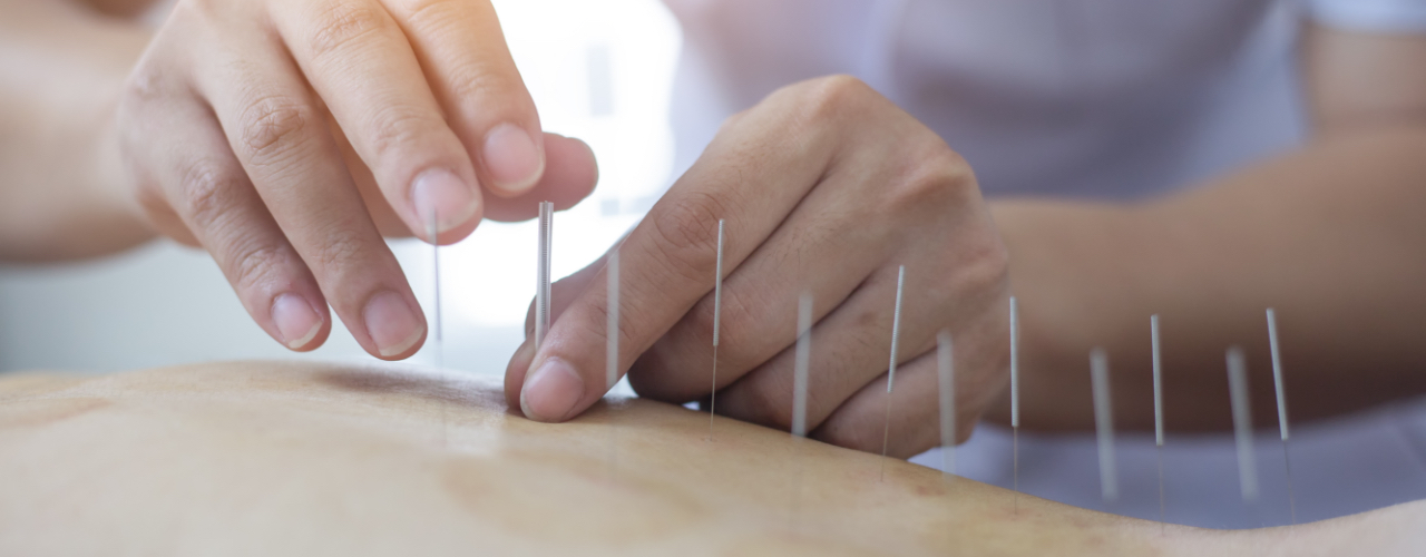 Dry-Needling-Aegis-Chiropractic-&-Physical-Therapy-Hadley-MA-1